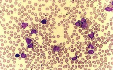 Peripheral smear of a patient with chronic myeloge