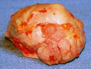 An enlarged ovary with a papillary serous carcinom