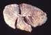 Emphysema