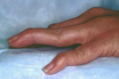 Changes in the hand caused by rheumatoid arthritis