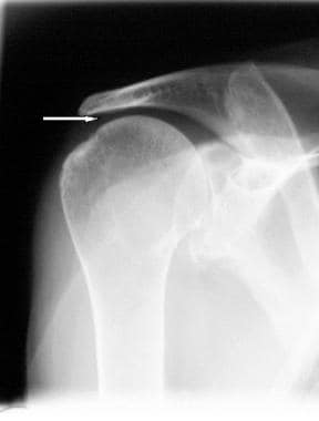 Superior migration of the humeral head in chronic,