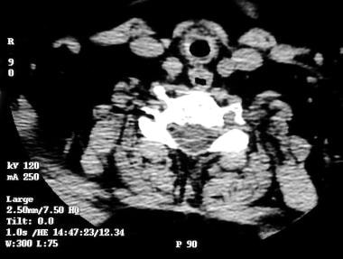 CT image showing tracheal narrowing in a 58-year-o