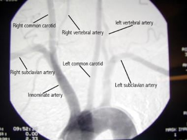 Arteriogram of aortic arch and its branches. 