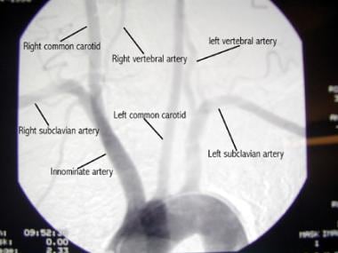 主动脉弓及其分支的动脉造影。