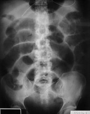Radiograph of a 79-year-old woman with several hou