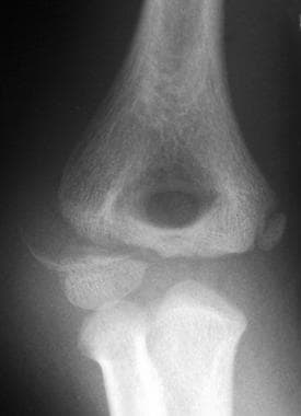 Lateral condyle fracture. 