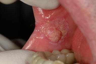 Early oral squamous cell carcinoma in the buccal m