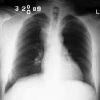 Congenital Lung Malformations. Bronchogenic cyst. 