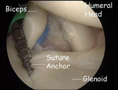Arthroscopic placement of a suture anchor in the s