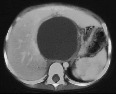 This CT scan of the abdomen in the region of the p