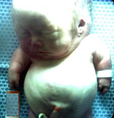患有软骨发育不全II型的婴儿。注意,维