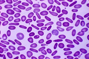 Hereditary elliptocytosis: Peripheral blood smear 
