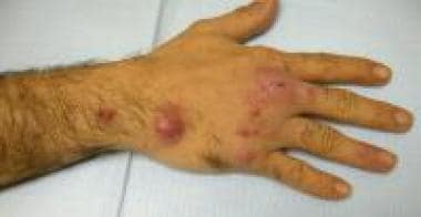 Cutaneous, ulcerating, painless nodule on the hand