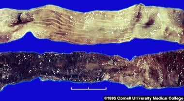 necrotizing enterocolitis histology