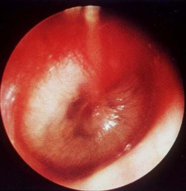 normal tympanic membrane vs bulging