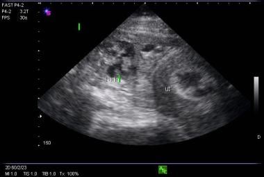 Picture of uterus without a fetal pole and a compl