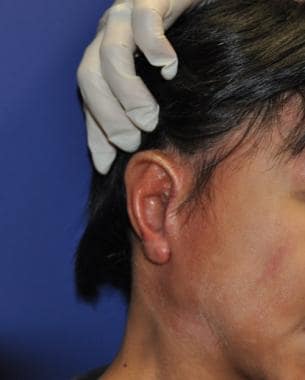Patient shown underwent second stage of microtia s