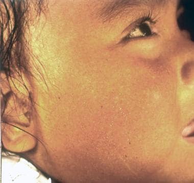 Skin of a Latin American child with erisípela de l