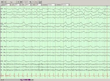 Periodic lateralized epileptiform discharges (PLED