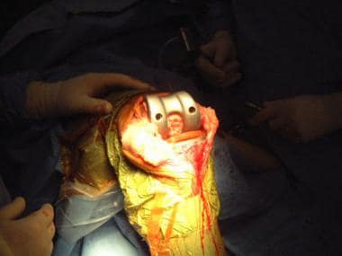 Total knee arthroplasty. Intraoperative photograph
