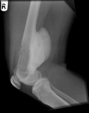 Plain radiograph showing increased opacity in lesi