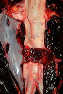 A stab wound of the inferior vena cava, as well as