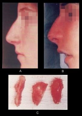 Nasal tip elevation. (A) Preoperative profile. (B)