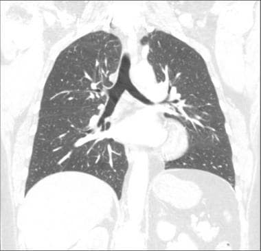 CT scan of chest (coronal view). Trachea, main car