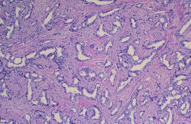 Breast cancer. Infiltrating ductal carcinoma. Low-