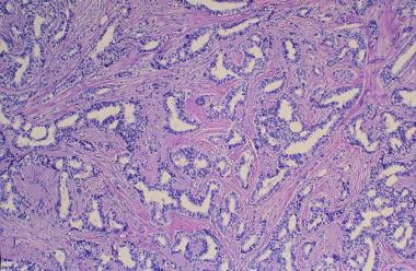 invasive ductal carcinoma histology