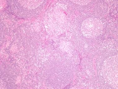 Multiple granulomas in the pericolic lymph nodes o