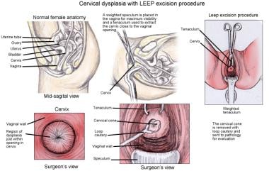 hpv treatment leep electrosurgical excision procedure viermi mici albi in scaun