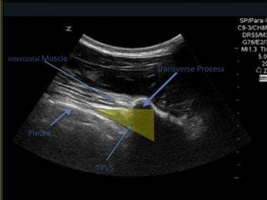 Transverse imaging at the correct level between tw