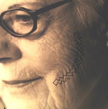 Design of W-plasty in cheek scar revision. 