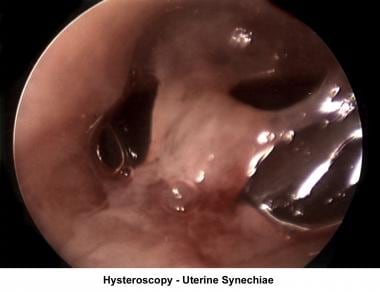 Infertility. Hysteroscopy - Uterine synechiae. Ima