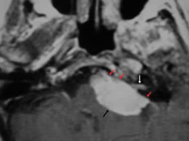 Cerebellopontine angle meningioma. Axial contrast-