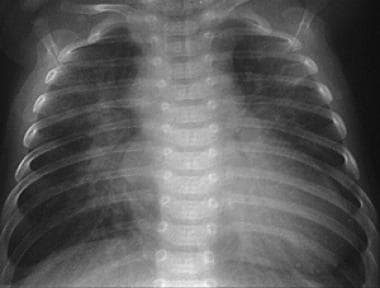Plain frontal chest radiograph in an infant with t