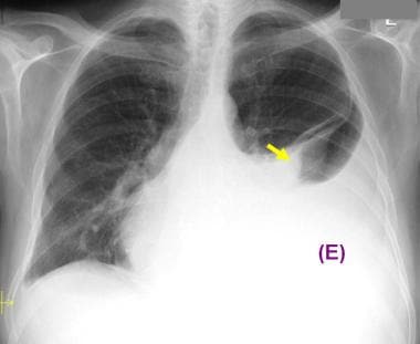 Lateral Decubitus Pleural Effusion