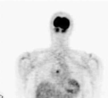 A positron emission tomography (PET) scan obtained