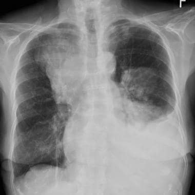 Chest radiograph in a 57-year-old woman with leiom