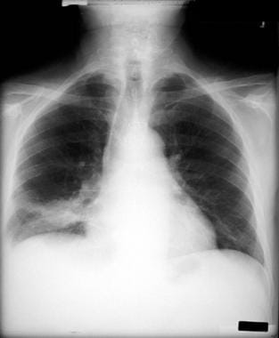 Non–small cell lung cancer. Patient has right lowe
