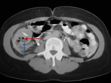  Bowel  Trauma Imaging Overview Radiography Computed 