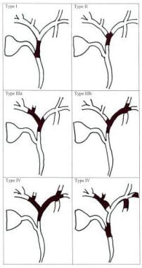 Bismuth classification for perihilar cholangiocarc