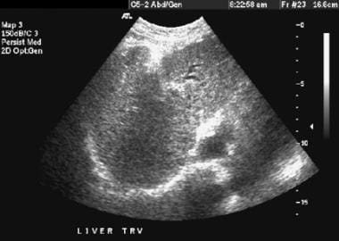Female patient with cirrhosis showing "coarsened" 