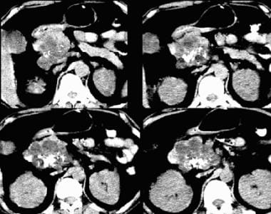 Serous cystadenoma on a nonenhanced CT scan. Note 