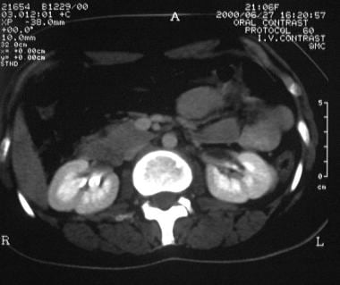 Axial computed tomography scan of the kidneys in a