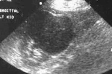 Case 2. Large renal cell carcinoma. Sonogram. 