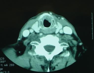CT scan shows a subglottic cancer along the cricoi