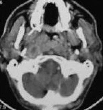 Contrast-enhanced CT scan shows nasopharyngeal car