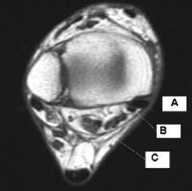 Axial T1-weighted image of the right ankle just ab